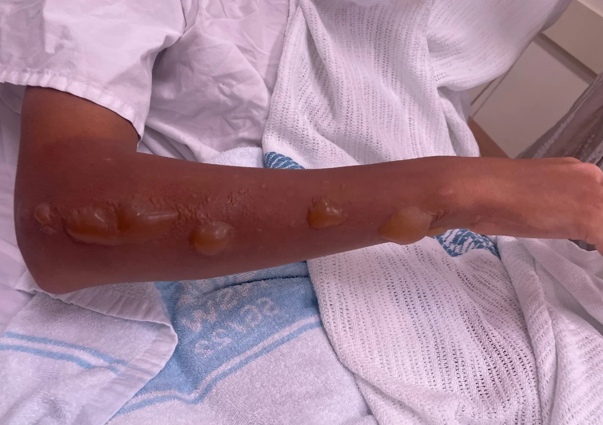 Stockton Beach incident